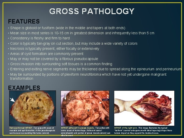 GROSS PATHOLOGY FEATURES • Shape is globoid or fusiform (wide in the middle and