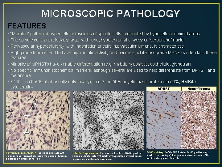 MICROSCOPIC PATHOLOGY FEATURES • “Marbled” pattern of hypercellular fascicles of spindle cells interrupted by