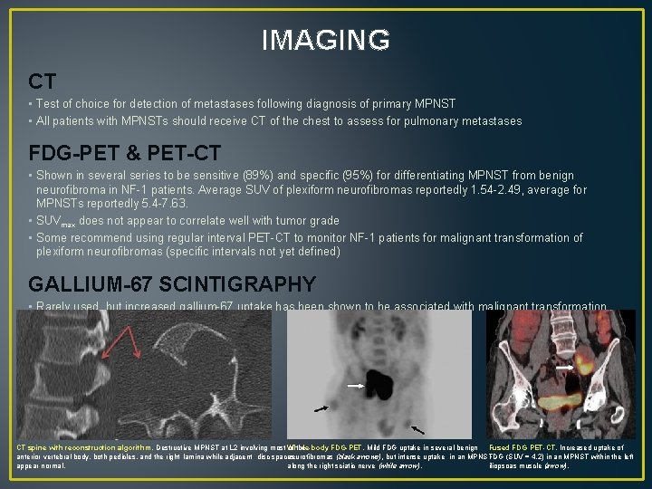IMAGING CT • Test of choice for detection of metastases following diagnosis of primary