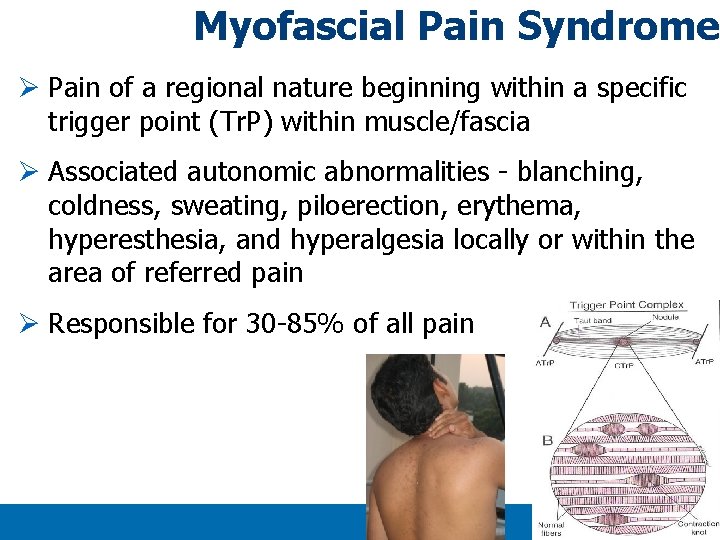 Myofascial Pain Syndrome Ø Pain of a regional nature beginning within a specific trigger Myofascial Pain Syndrome Ø Pain of a regional nature beginning within a specific trigger