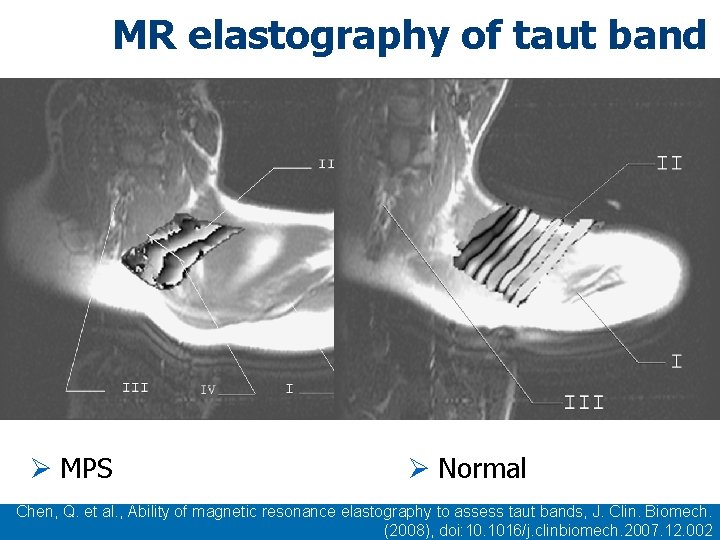 MR elastography of taut band Ø MPS Ø Normal Chen, Q. et al. , MR elastography of taut band Ø MPS Ø Normal Chen, Q. et al. ,