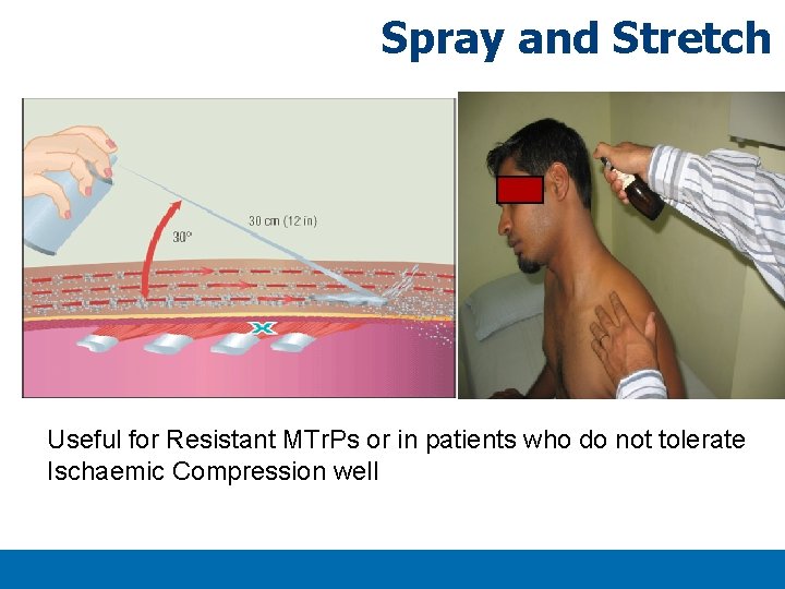 Spray and Stretch Useful for Resistant MTr. Ps or in patients who do not Spray and Stretch Useful for Resistant MTr. Ps or in patients who do not