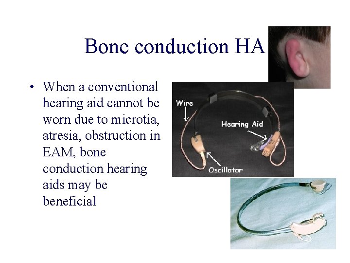 Bone conduction HA • When a conventional hearing aid cannot be worn due to