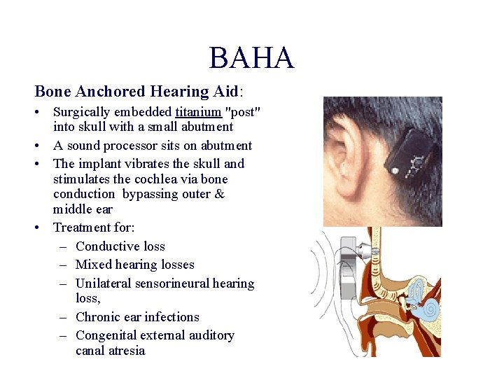 BAHA Bone Anchored Hearing Aid: • Surgically embedded titanium "post" into skull with a