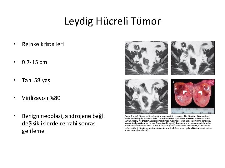 Leydig Hücreli Tümor • Reinke kristalleri • 0. 7 -15 cm • Tanı 58