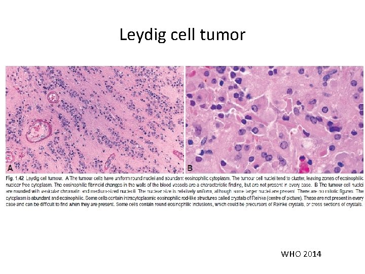 Leydig cell tumor WHO 2014 