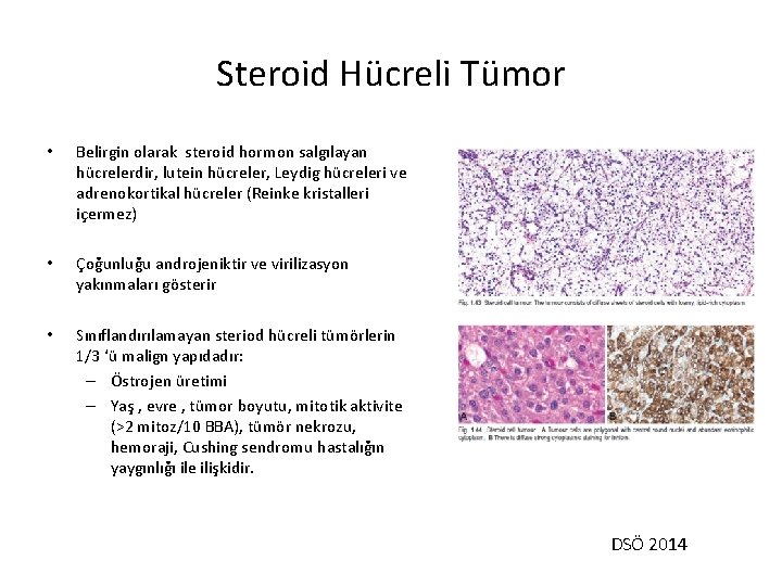 Steroid Hücreli Tümor • Belirgin olarak steroid hormon salgılayan hücrelerdir, lutein hücreler, Leydig hücreleri