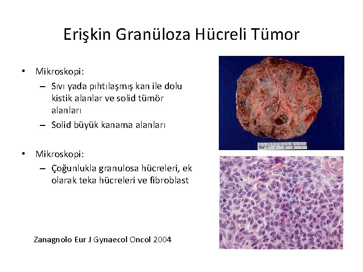 Erişkin Granüloza Hücreli Tümor • Mikroskopi: – Sıvı yada pıhtılaşmış kan ile dolu kistik