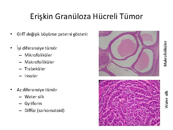 Erişkin Granüloza Hücreli Tümor • Az diferansiye tümör – Water silk – Gyriform –