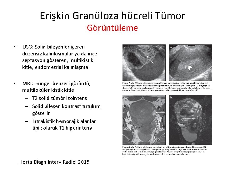 Erişkin Granüloza hücreli Tümor Görüntüleme • USG: Solid bileşenler içeren düzensiz kalınlaşmalar ya da