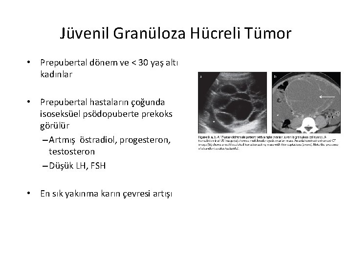 Jüvenil Granüloza Hücreli Tümor • Prepubertal dönem ve < 30 yaş altı kadınlar •