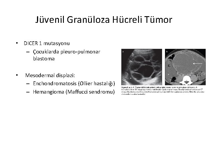 Jüvenil Granüloza Hücreli Tümor • DICER 1 mutasyonu – Çocuklarda pleuro-pulmonar blastoma • Mesodermal