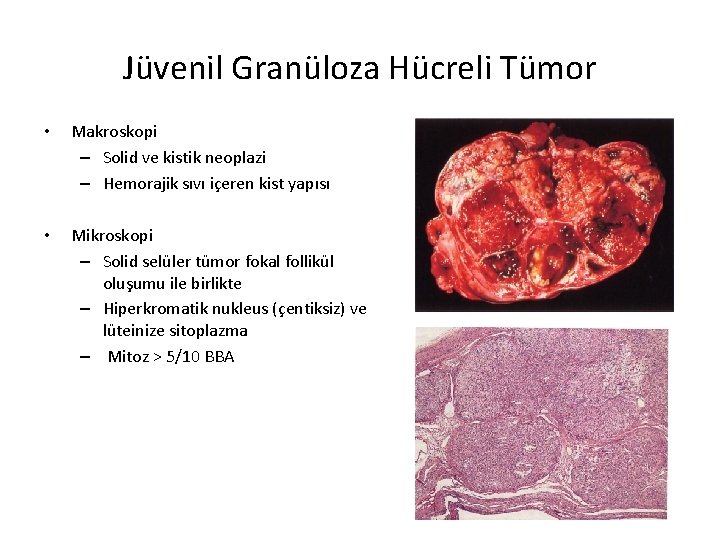 Jüvenil Granüloza Hücreli Tümor • Makroskopi – Solid ve kistik neoplazi – Hemorajik sıvı