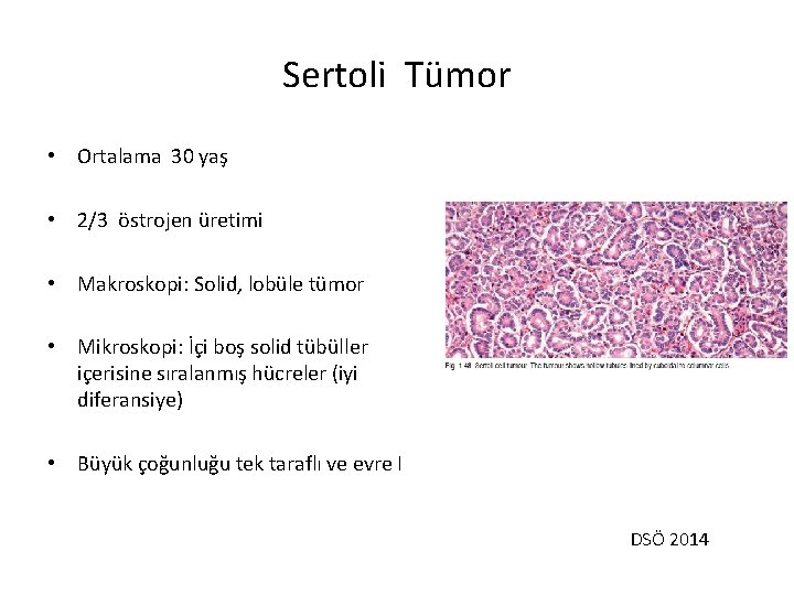 Sertoli Tümor • Ortalama 30 yaş • 2/3 östrojen üretimi • Makroskopi: Solid, lobüle