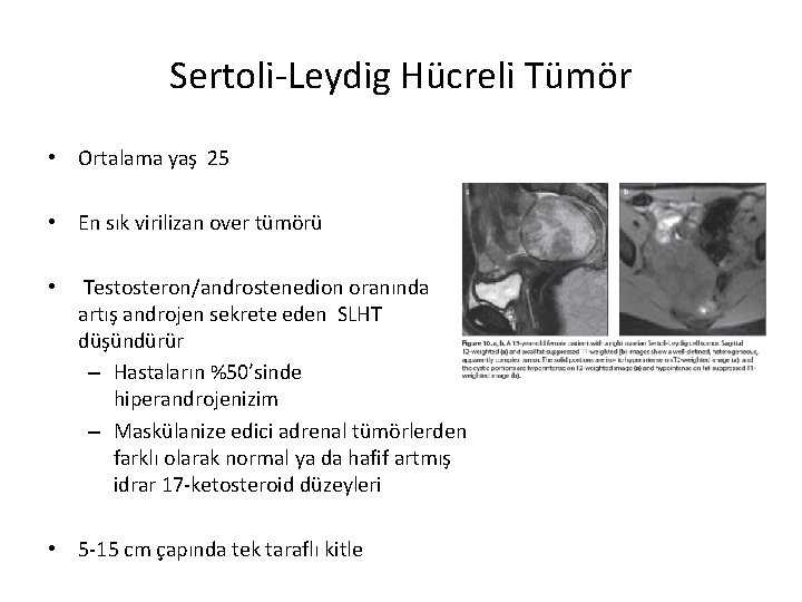 Sertoli-Leydig Hücreli Tümör • Ortalama yaş 25 • En sık virilizan over tümörü •