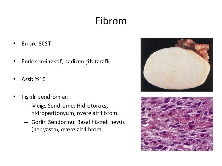 Fibrom • En sık SCST • Endokrin-inaktif, nadiren çift taraflı • Assit %10 •