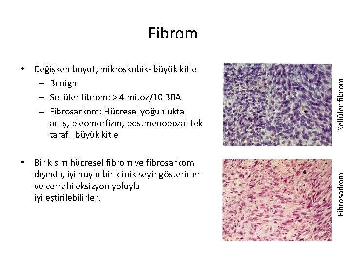  • Bir kısım hücresel fibrom ve fibrosarkom dışında, iyi huylu bir klinik seyir