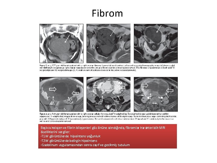 Fibrom Başlıca kolajen ve fibrin bileşenleri göz önüne alındığında, fibromlar karakteristik MRI özelliklerini sergiler: