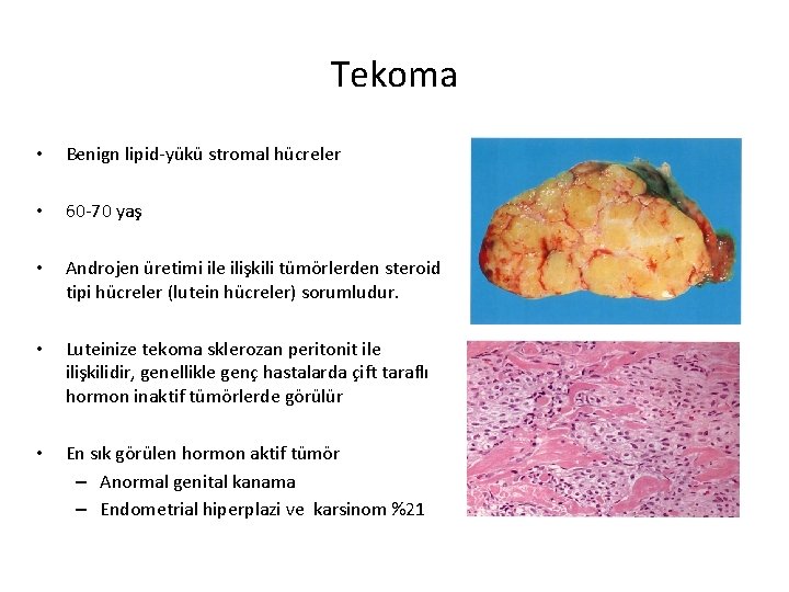 Tekoma • Benign lipid-yükü stromal hücreler • 60 -70 yaş • Androjen üretimi ile