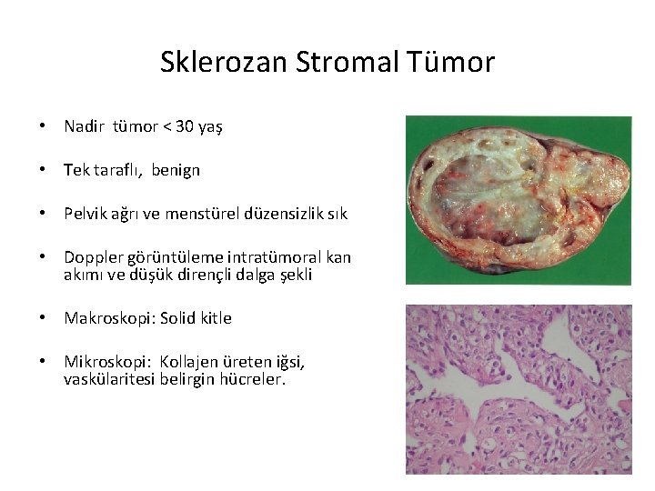 Sklerozan Stromal Tümor • Nadir tümor < 30 yaş • Tek taraflı, benign •