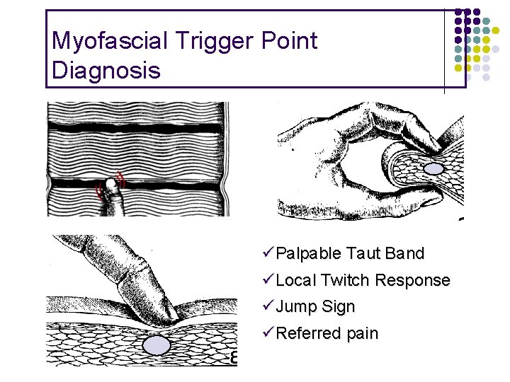 Myofascial Trigger Point Diagnosis Palpable Taut Band Local Twitch Response Jump Sign Referred pain