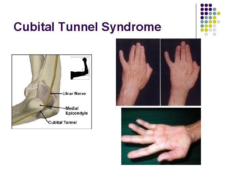 Cubital Tunnel Syndrome 