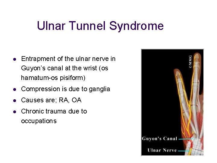 Ulnar Tunnel Syndrome l Entrapment of the ulnar nerve in Guyon’s canal at the