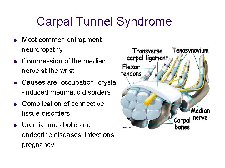 Carpal Tunnel Syndrome l Most common entrapment neuroropathy l Compression of the median nerve