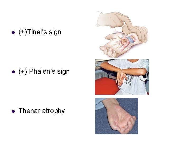 l (+)Tinel’s sign l (+) Phalen’s sign l Thenar atrophy 