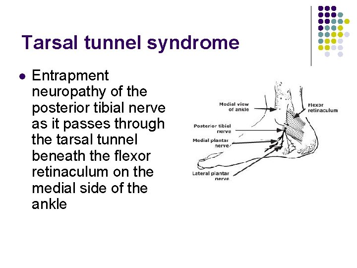 Tarsal tunnel syndrome l Entrapment neuropathy of the posterior tibial nerve as it passes