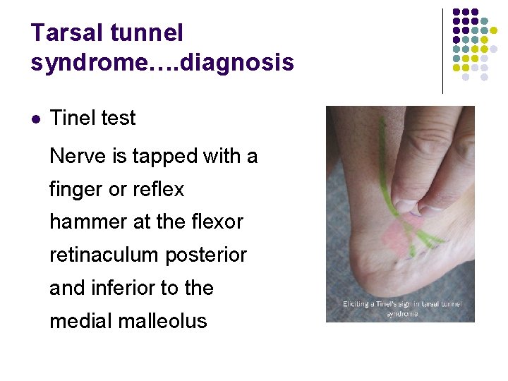 Tarsal tunnel syndrome…. diagnosis l Tinel test Nerve is tapped with a finger or