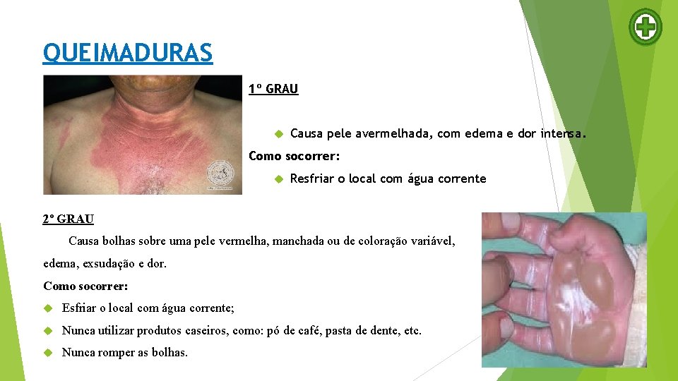 QUEIMADURAS 1º GRAU Causa pele avermelhada, com edema e dor intensa. Como socorrer: Resfriar