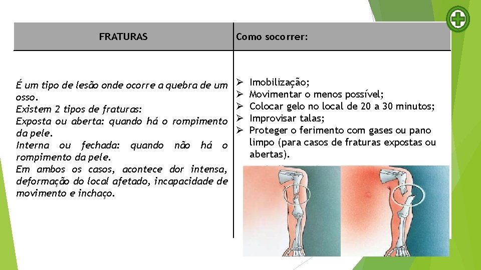 FRATURAS É um tipo de lesão onde ocorre a quebra de um osso. Existem