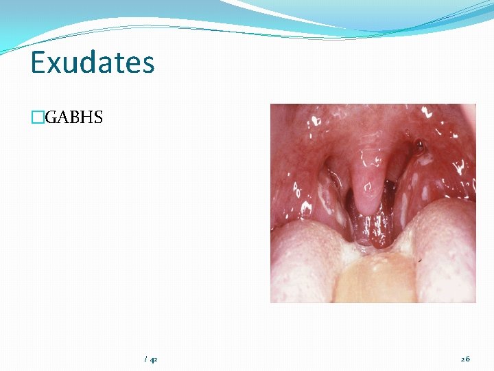 Exudates �GABHS / 42 26 