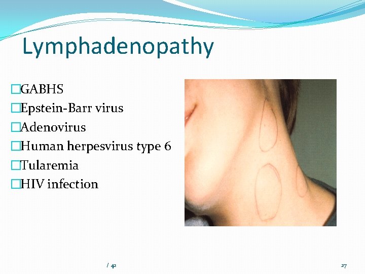 Lymphadenopathy �GABHS �Epstein-Barr virus �Adenovirus �Human herpesvirus type 6 �Tularemia �HIV infection / 42
