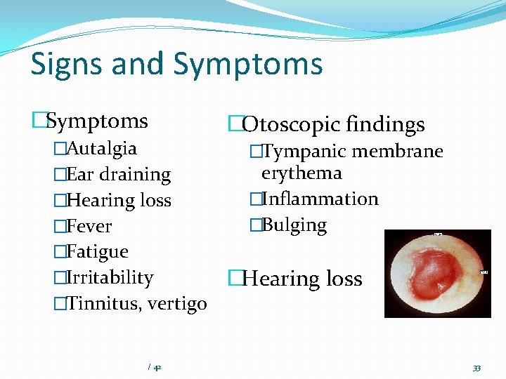 Signs and Symptoms �Autalgia �Ear draining �Hearing loss �Fever �Otoscopic findings �Tympanic membrane erythema