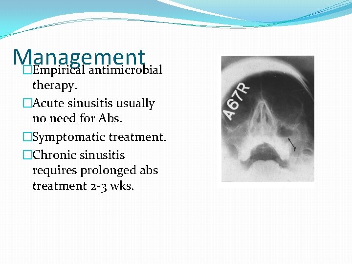Management �Empirical antimicrobial therapy. �Acute sinusitis usually no need for Abs. �Symptomatic treatment. �Chronic