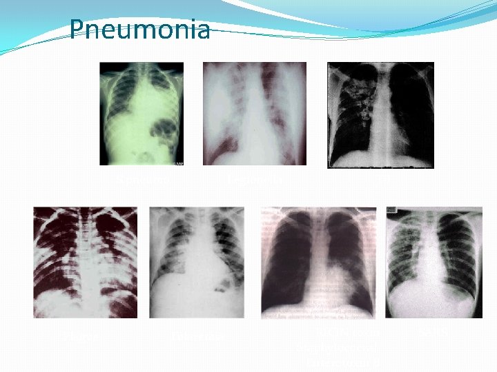 Pneumonia S. pneumo Plague Tularemia Legionella TB RICIN toxin Staphylococcal Enterotoxin B SARS 