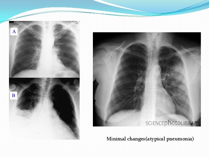 Minimal changes(atypical pneumonia) 