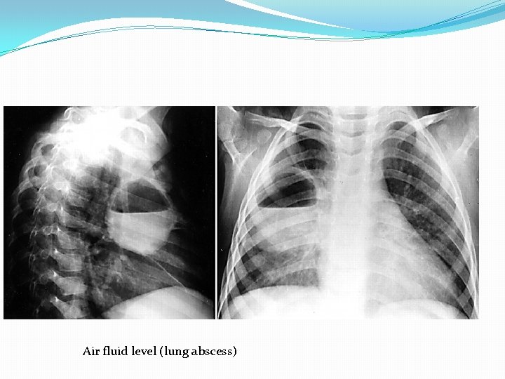 Air fluid level (lung abscess) 