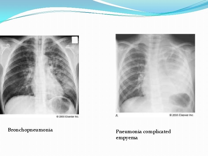 Bronchopneumonia Pneumonia complicated empyema 