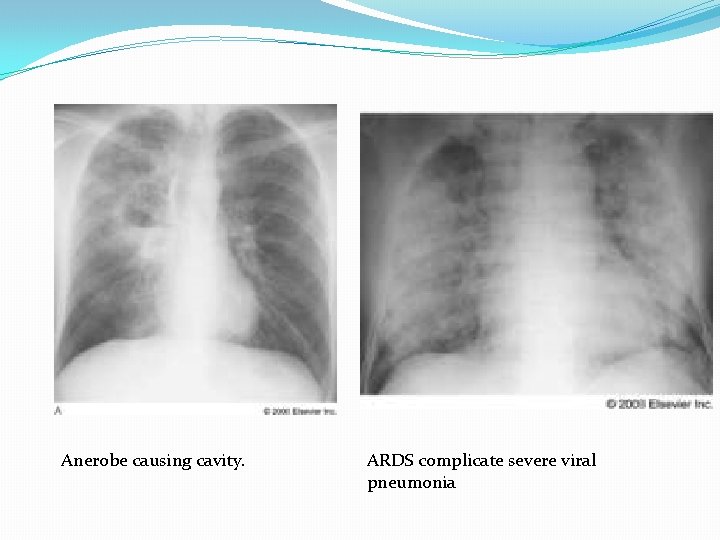 Anerobe causing cavity. ARDS complicate severe viral pneumonia 