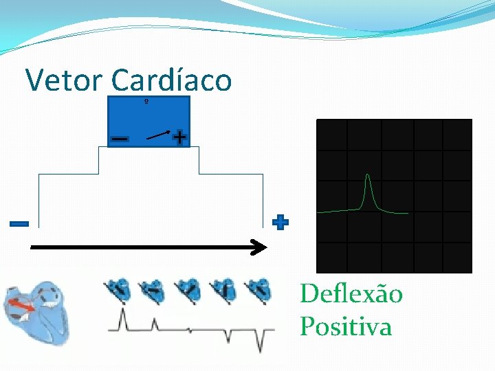 Vetor Cardíaco º Deflexão Positiva 