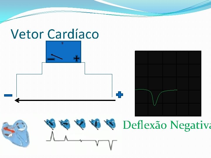 Vetor Cardíaco º Deflexão Negativa 
