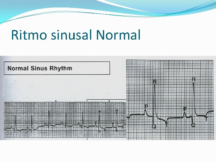 Ritmo sinusal Normal 
