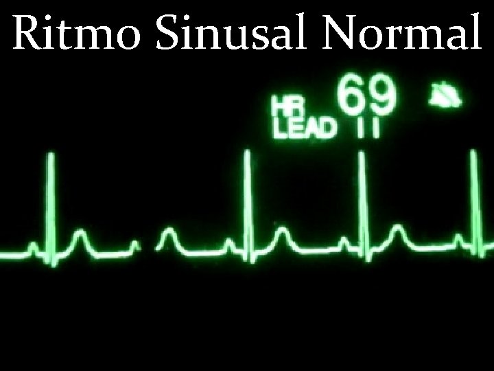 Ritmo Sinusal Normal 