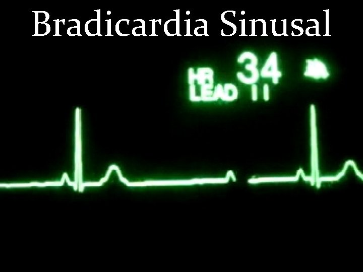 Bradicardia Sinusal 