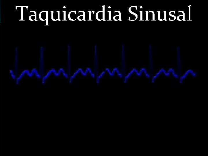 Taquicardia Sinusal 