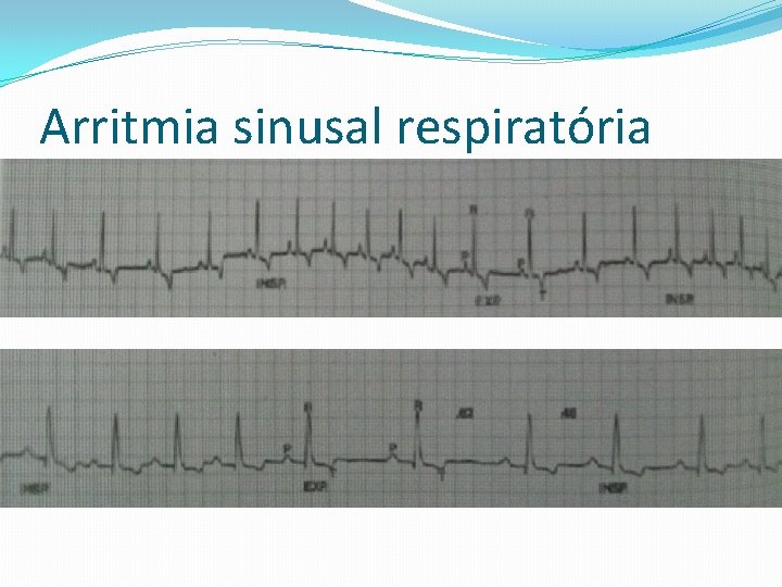 Arritmia sinusal respiratória 