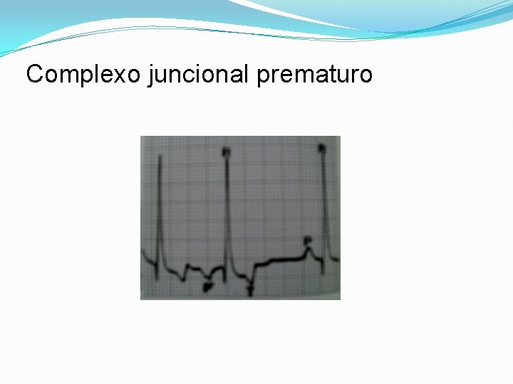 Complexo juncional prematuro 